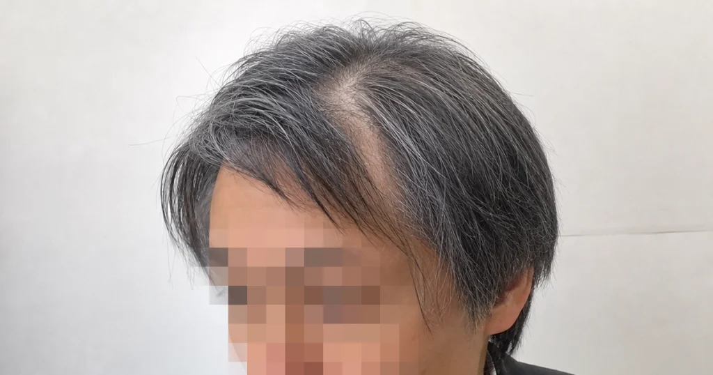 左の側頭部の髪が割れてる画像