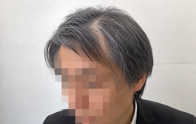 左の側頭部の髪が割れてる画像