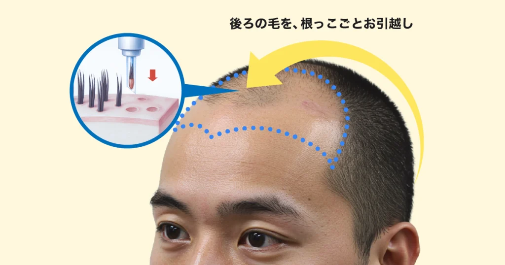 自毛植毛を知った画像