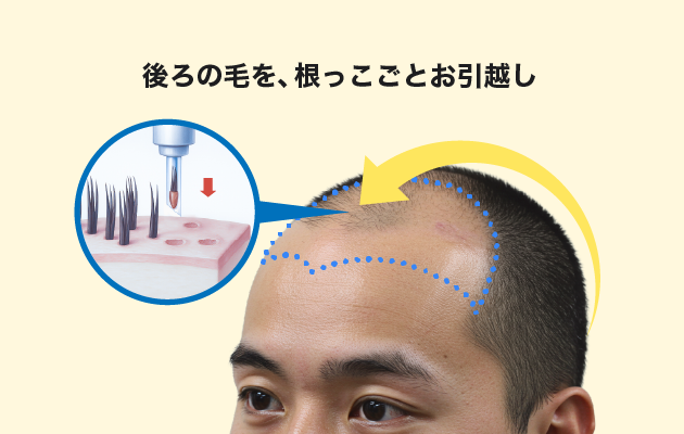 自毛植毛を知った画像